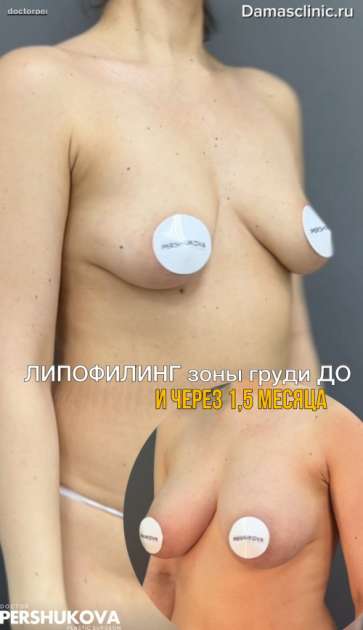 Липофилинг зоны груди до и через 1,5 месяца с фото и видео результатом