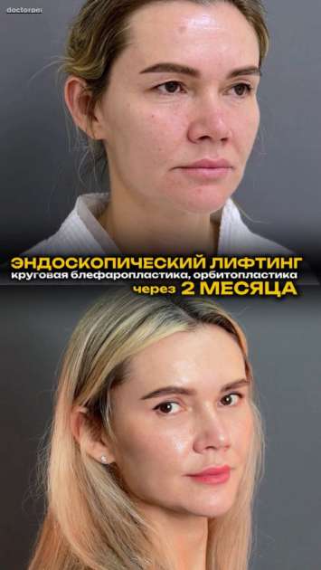 Эндоскопический лифтинг, круговая блефаропластика, орбитопластика с фото и видео через 8 недель