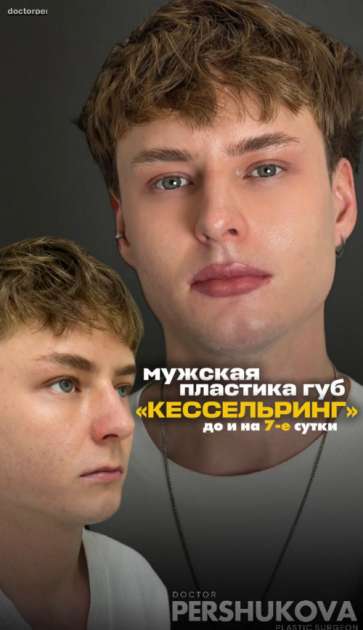 Мужская пластика губ «Кессельринг»: как выглядят швы через неделю?