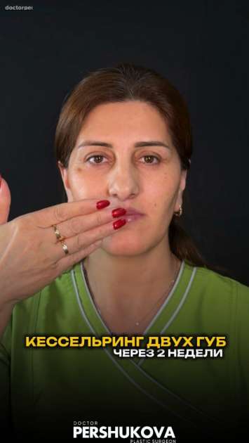 Комплексная пластика губ «КЕССЕЛЬРИНГ» и «БУЛХОРН / BULLHORN»: до и через 2 недели после на плановом осмотре с фото и видео