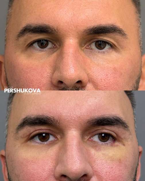 Мужская верхняя блефаропластика: до и через неделю после операции с фото